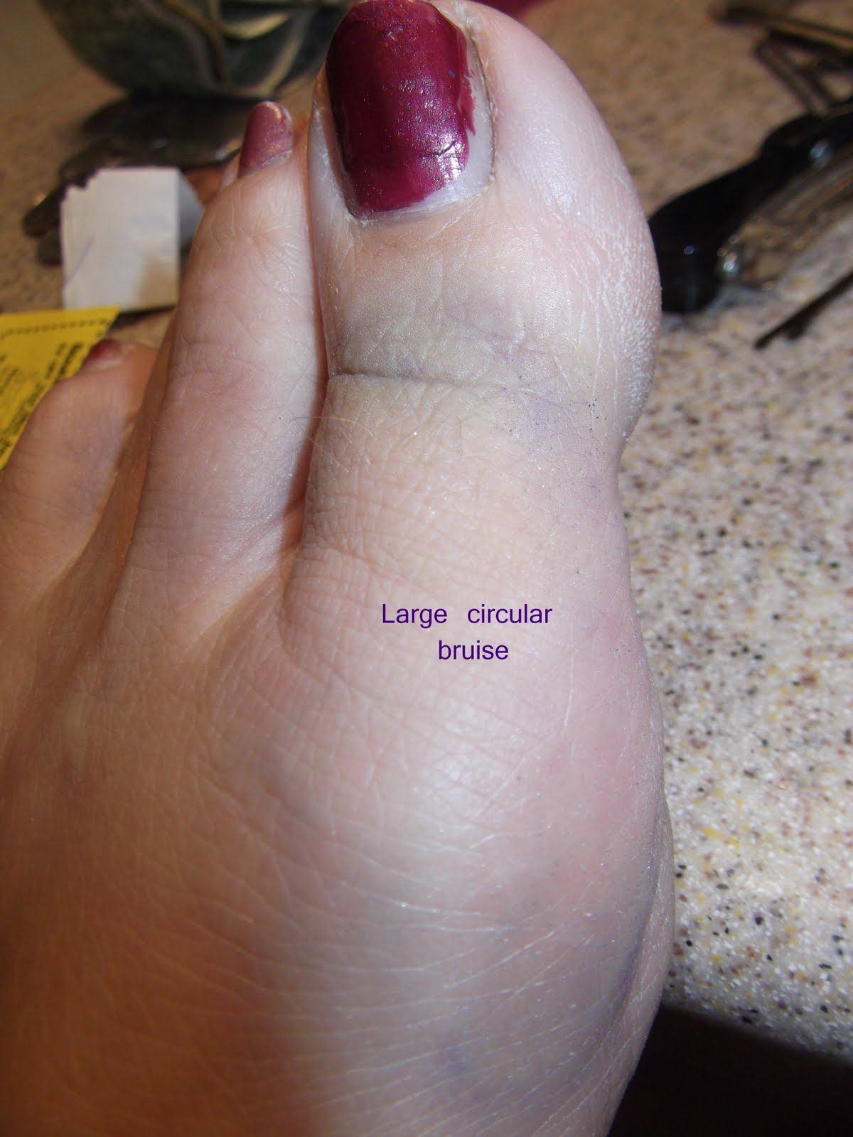 D & B DeWitt Family Big Toe Bruise