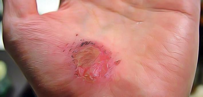 comment cicatriser une plaie naturellement comment cicatriser une plaie naturellement