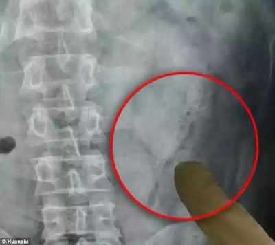 000 Drunk man is left needing surgery after he stuck two live fish up his anus and one swam into his abdomen