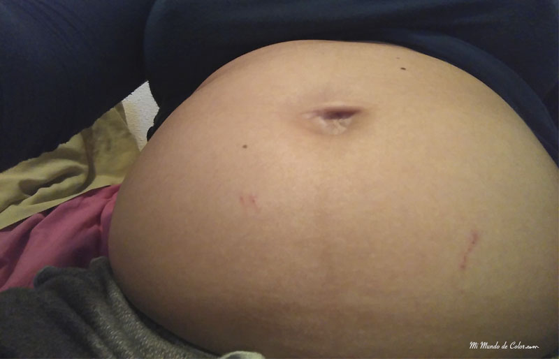 mi embarazo y la amniocentesis