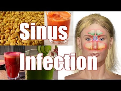 Steroids for treating sinus infection