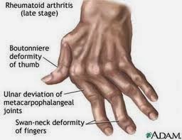 rawatan sakit sendi (arthritis)