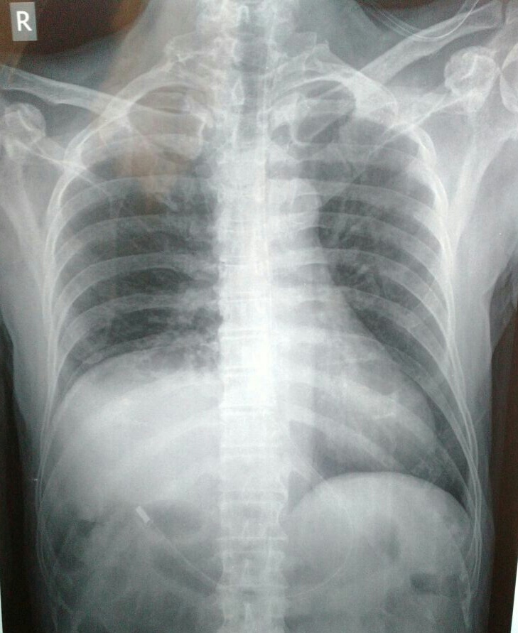 Chest Medicine Made EasyDr Deepu Diaphragm Palsy