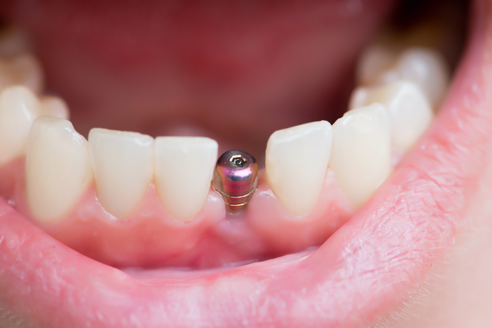 Dental Implants Procedure Pros Cons And Risks Involved
