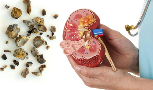 Kidney Stone Disease, Causes, Symptoms, Prevention and Treatment. Kidney Stone Disease, Causes, Symptoms, Prevention and Treatment.