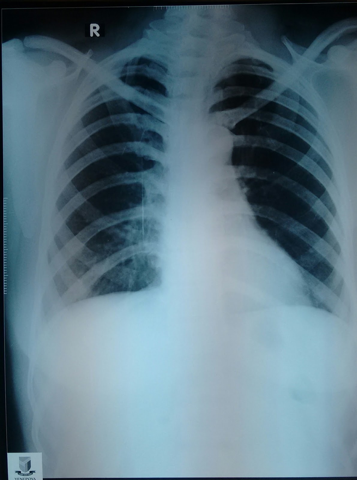 chest medicine made easy dr deepu the cervical rib