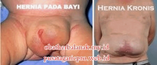Obat Hernia Yang Sudah Terbukti Ampuh Obat Hernia Yang Sudah Terbukti Ampuh