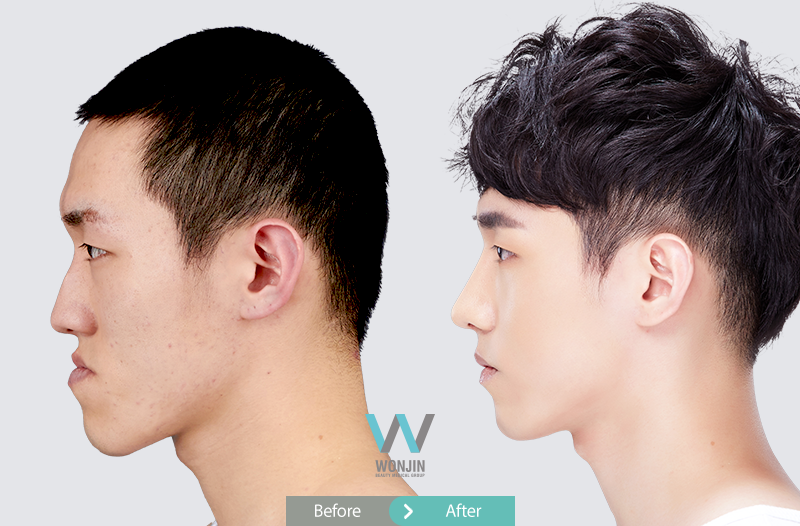 Protruded mouth can be treated and improved by twojaw surgery