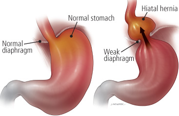 hiatal hernia diagram gastric hernia symptoms and hiatal hernia diet hiatal hernia diagram gastric hernia symptoms and hiatal hernia diet