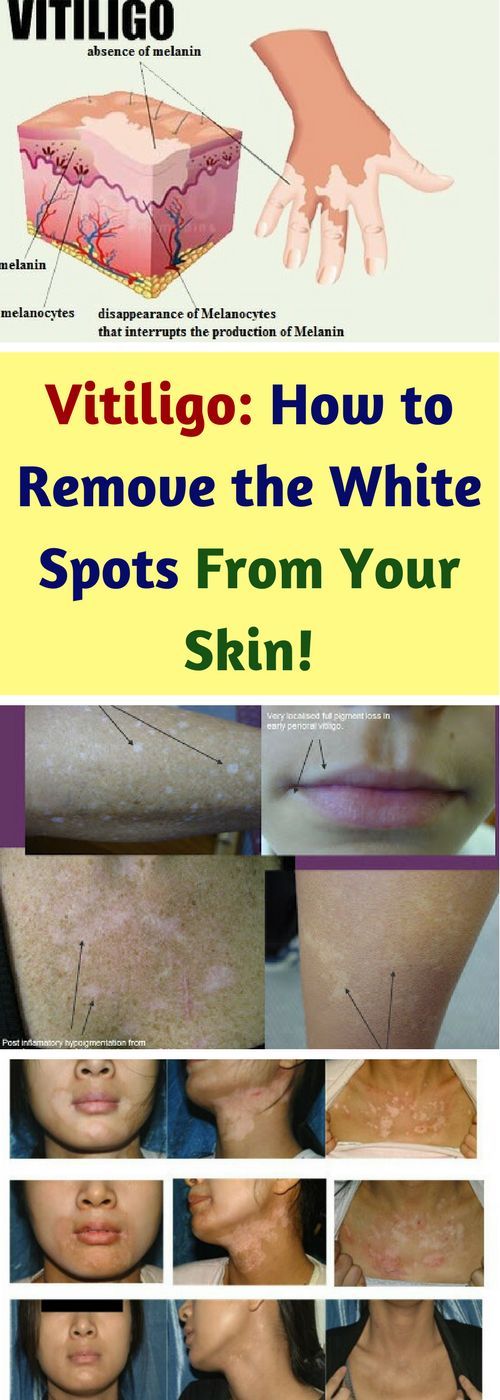 Vitiligo How To Remove The White Spots From Your Skin!!! Health at Home