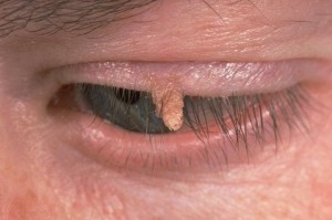 Wart On Eyelid - Doctor answers on HealthTap