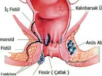 Obat Salep Ambeien Luar Obat Salep Ambeien Luar