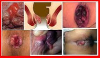 Image Bagaimana Cara Sembuhkan Wasir Dengan Obat Herbal ?