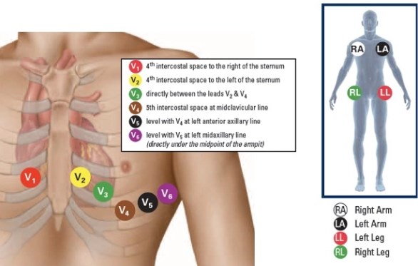 chart strip ekg Psvt