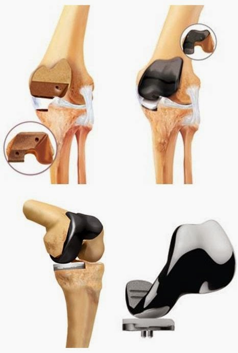 схема эндопротезирования коленного сустава. эндопротезирование коленного сустава операция.