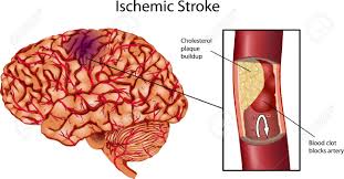 Obat Tradisional Penyakit Stroke Ringan, Bagaimana Cara Menyembuhkan Stroke Ringan Dengan Cepat?, Cara Mengatasi Penyakit Stroke Ringan