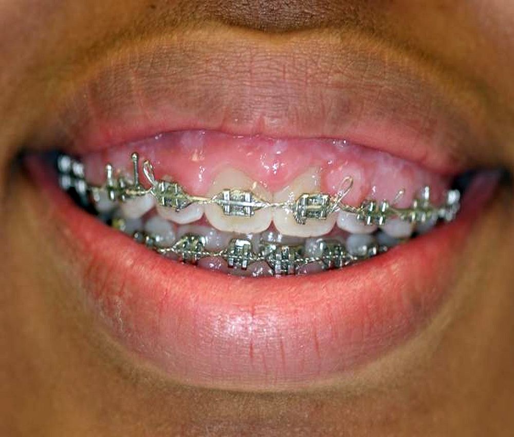 ORTHODONTICS Your braces could be causing gum problems Directorio