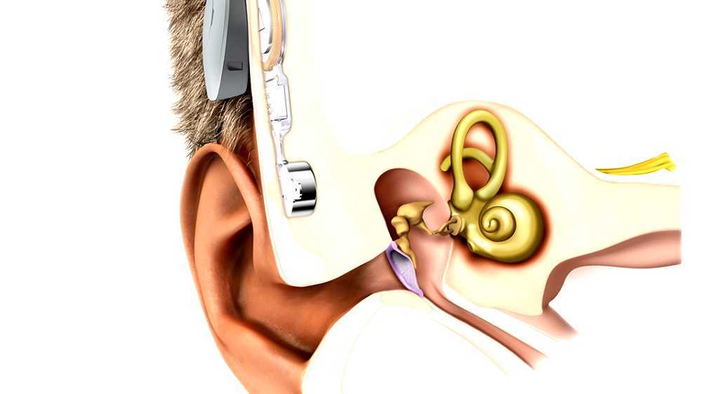Boneanchored hearing aid