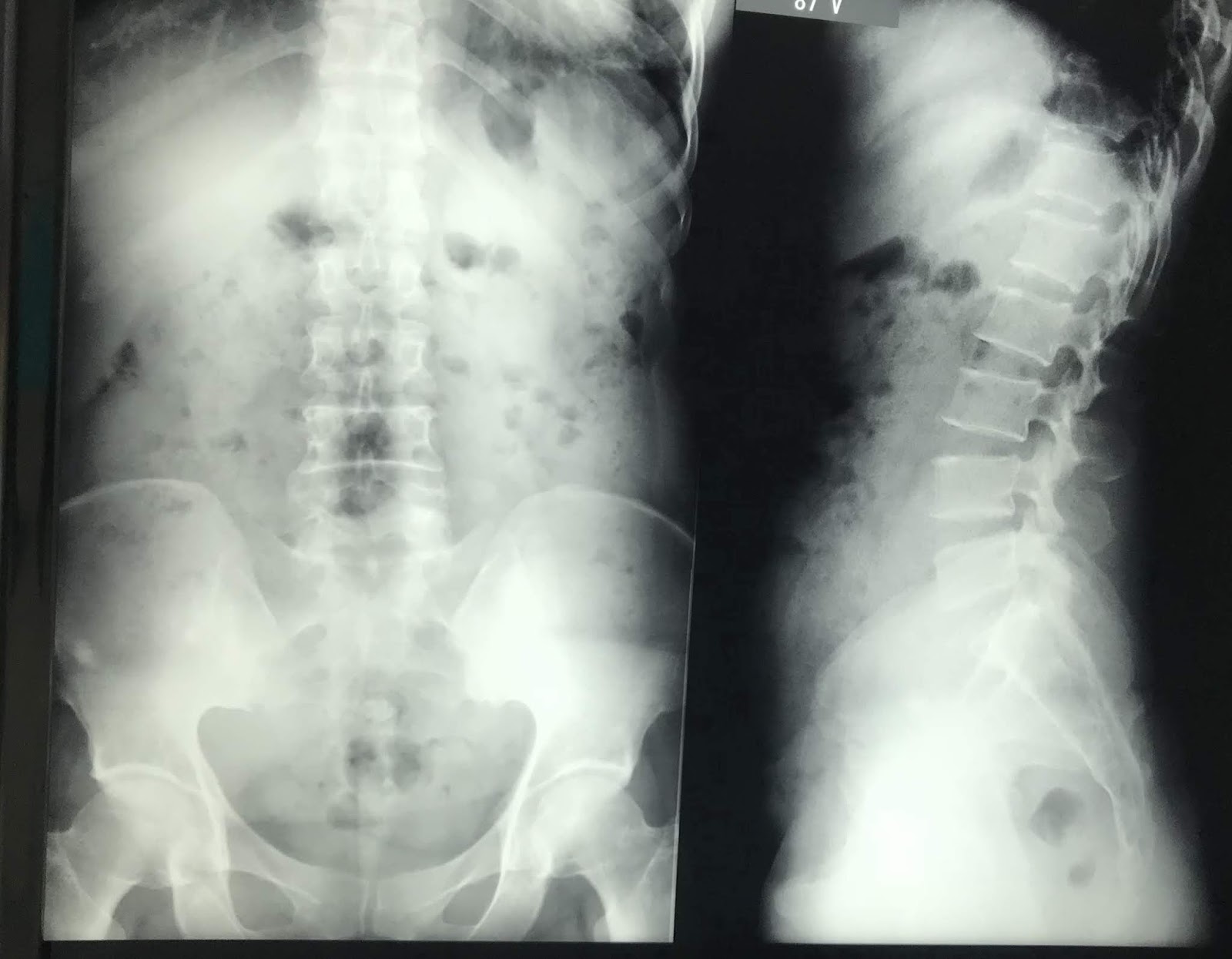 VIETNAMESE MEDIC ULTRASOUND CASE 519 LYMPHOMA in RETROPERITONEUM, Dr