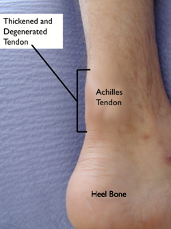 durere dureroasă la genunchi în repaus exerciții pentru durere în articulațiile picioarelor