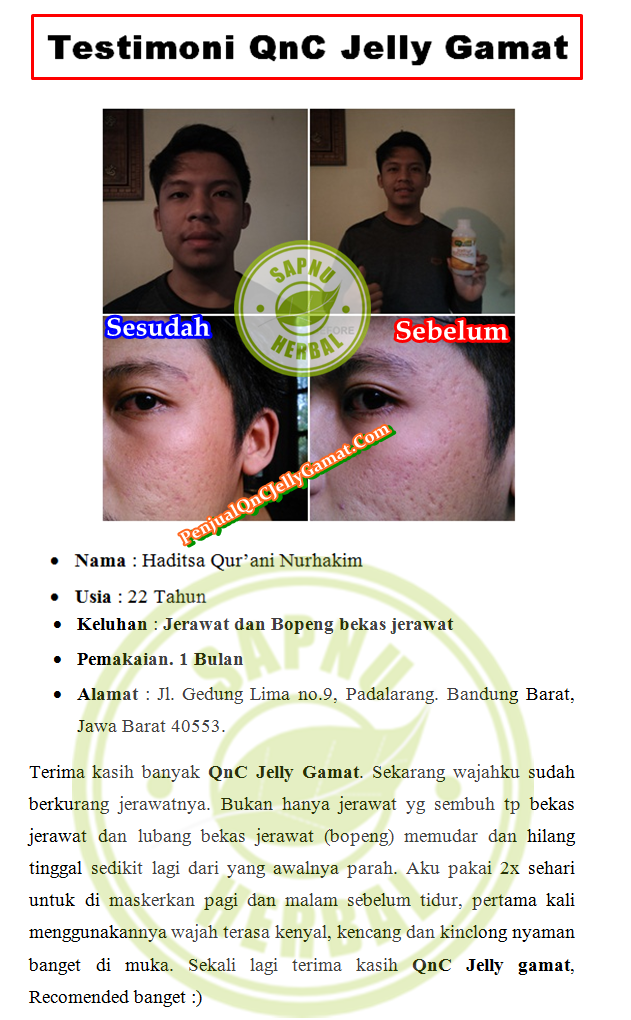 Cara Menghilangkan Jerawat Bernanah Dan Meradang Terbukti Manjur ~ TESTIMONI QNC JELLY GAMAT Cara Menghilangkan Jerawat Bernanah Dan Meradang Terbukti Manjur ~ TESTIMONI QNC JELLY GAMAT