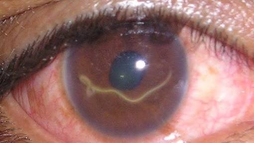 Dangerous Worms May Appear Inside Your Body If You Eat Too Much of These Types of Food. Beware!