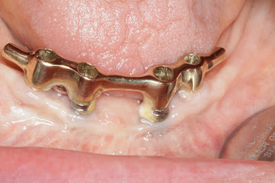 Zahnarzt Bochum: Implantate erhalten