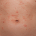 Sociedade Brasileira de Dermatologia fala sobre psoríase, preconceito e tratamentos para a doença que acabam de ser disponibilizados no SUS