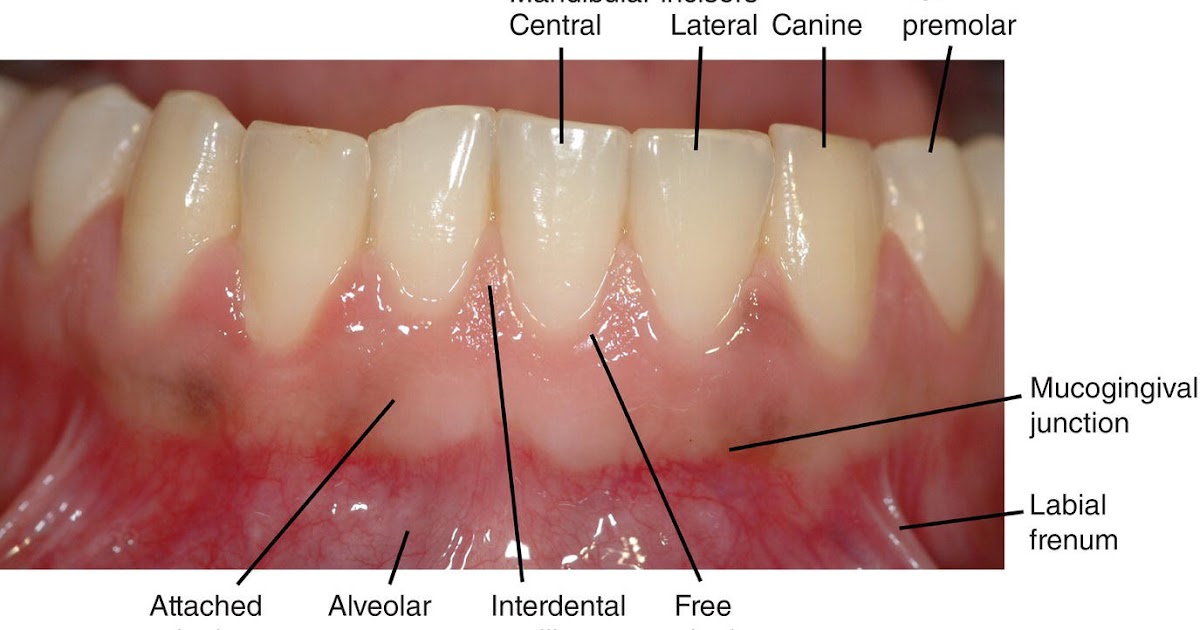 Mucogingival Junction