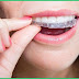 Băn khoăn niềng răng invisalign và clear aligner khác nhau thế nào?