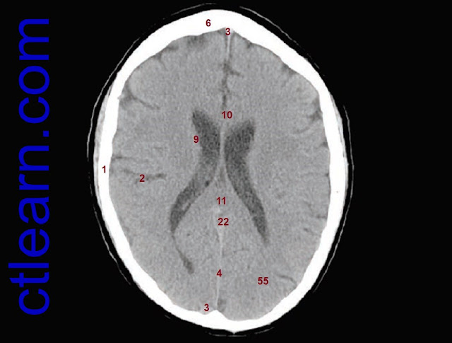 Anatomy CT Axial Brain
