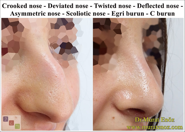 Female Nose Aesthetic Surgery - Nose Jobs For Women - Nose Reshaping for Women - Best Rhinoplasty For Women Istanbul - Female Rhinoplasty Istanbul - Nose Job Surgery for Women - Women's Rhinoplasty - Nose Aesthetic Surgery For Women - Female Rhinoplasty Surgery in Istanbul - Female Rhinoplasty Surgery in Turkey - Crooked nose - Deviated nose - Twisted nose - Deflected nose - Asymmetric nose - Scoliotic nose - Eğri burun - C burun - S-shaped crooked nose deformity -  Rhinoplasty Istanbul - Rhinoplasty in Istanbul - Rhinoplasty Turkey - Rhinoplasty in Turkey – Rhinoplasty doctor in Istanbul – ENT doctor in Istanbul - Nose Job in Istanbul - Before and after rhinoplasty photo
