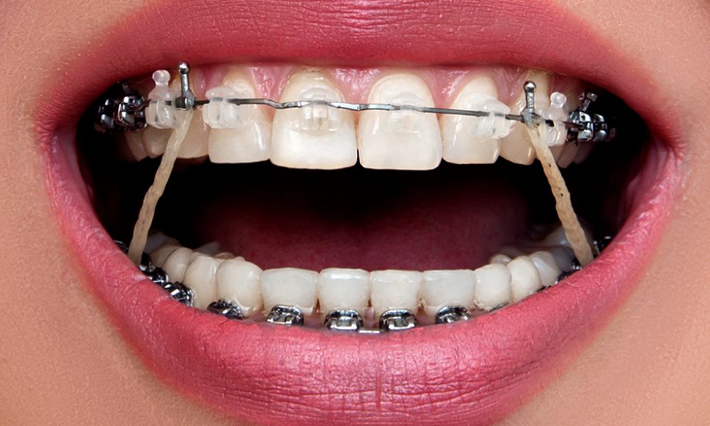 ORTHODONTICS Why do I have to wear rubber bands? Directorio