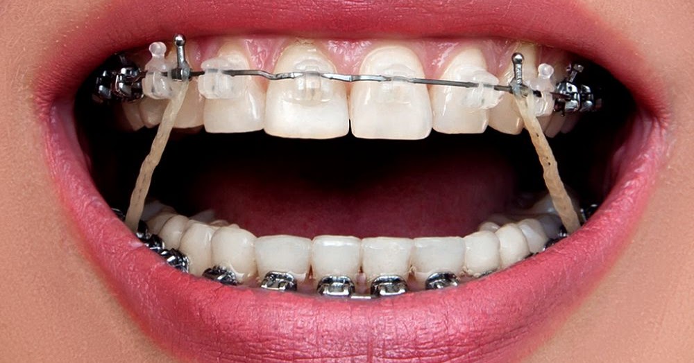 ORTHODONTICS Why do I have to wear rubber bands? Directorio