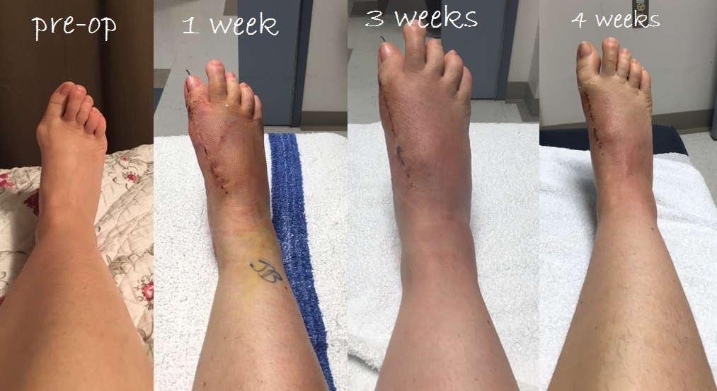 lapidus bunionectomy cast
