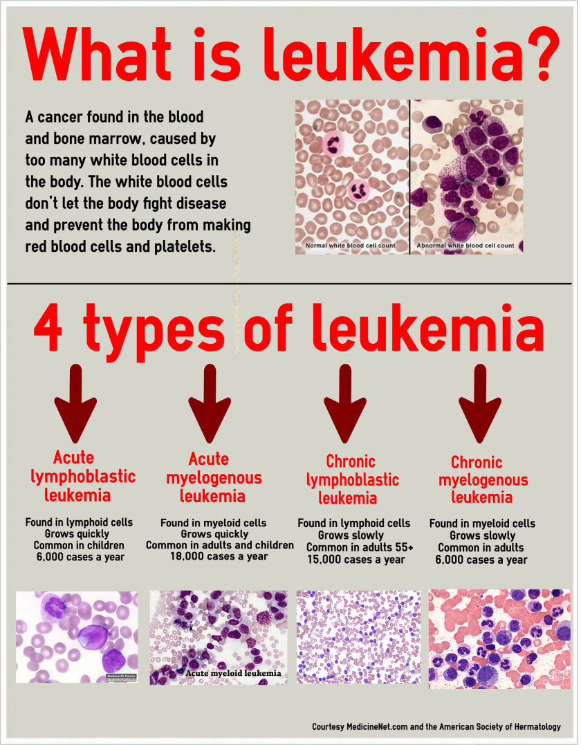 Leukemia Causes Symptoms And Treatment