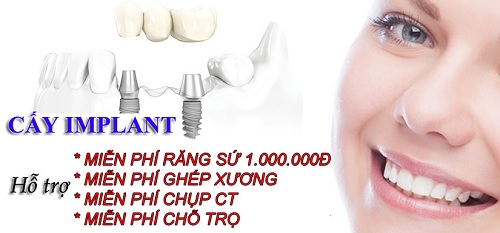 trồng răng cấm bằng phương pháp cấy ghép Implant - trồng răng cấm bằng phương pháp cấy ghép Implant -