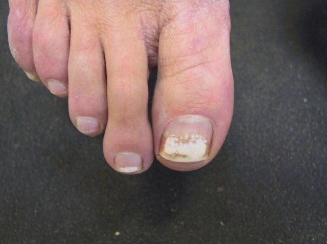 What Are White Spots On The Toenails - Design Talk