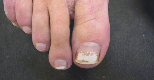 What Causes White Spots On Your Toenails - Design Talk