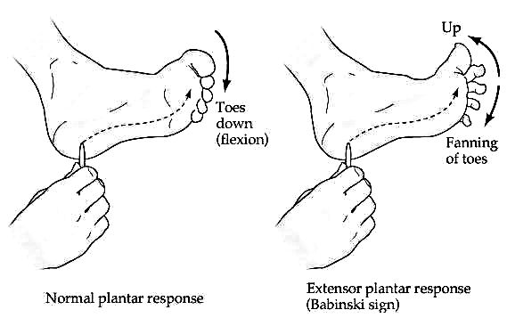 plantar-reflex plantar-reflex