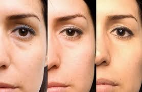 como quitar las ojeras rapido en hombres