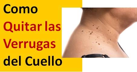 Como Quitar las Verrugas del Cuello de Forma Natural: Remedios Caseros | Mejor Tratamiento Natural