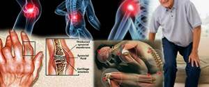 Obat Rematik Resep Dokter