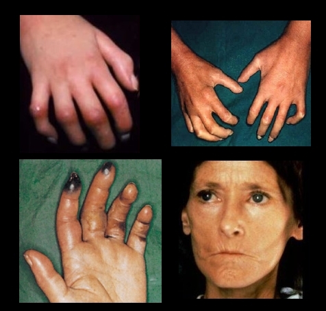 esclerodermia es hereditaria