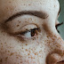 Did You Know That You Can Get Skin Cancer On Your Eyelid?