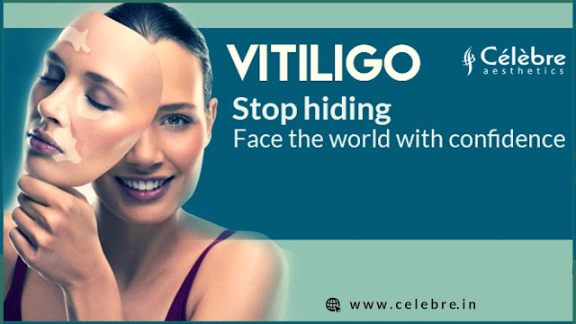 Vitiligo Treatment in Surat