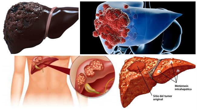 tratamiento de metastasis en el higado