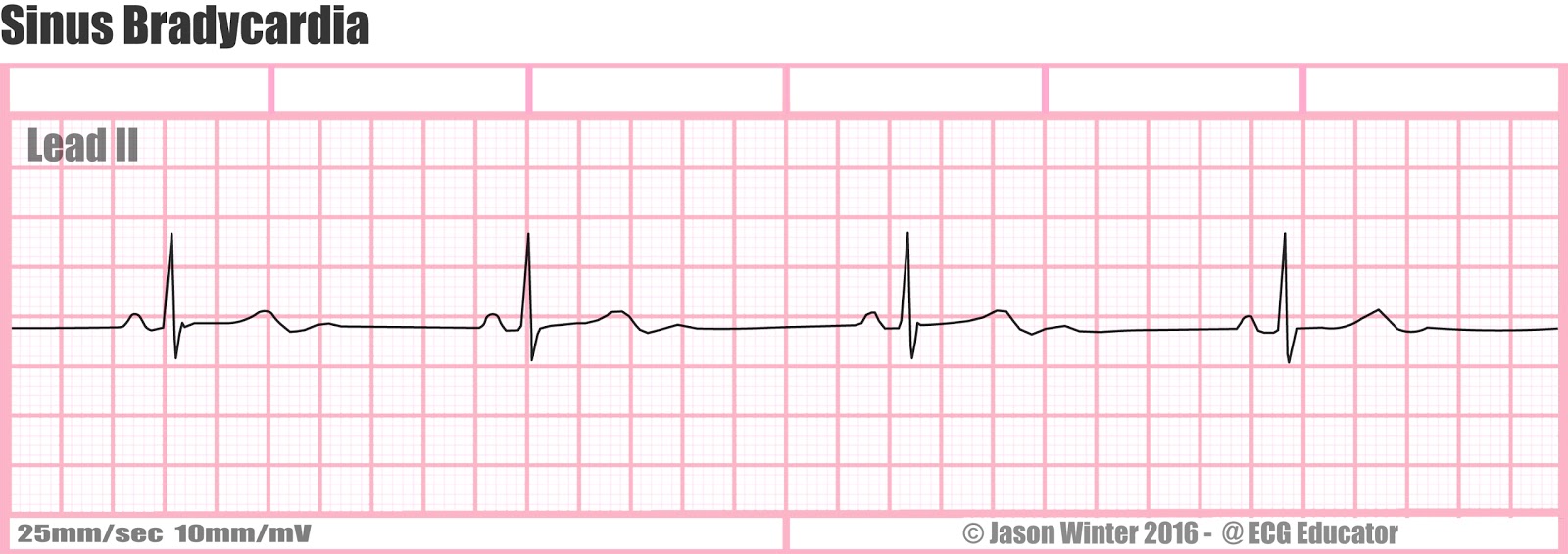ECG Educator Blog Sinus Bradycardia