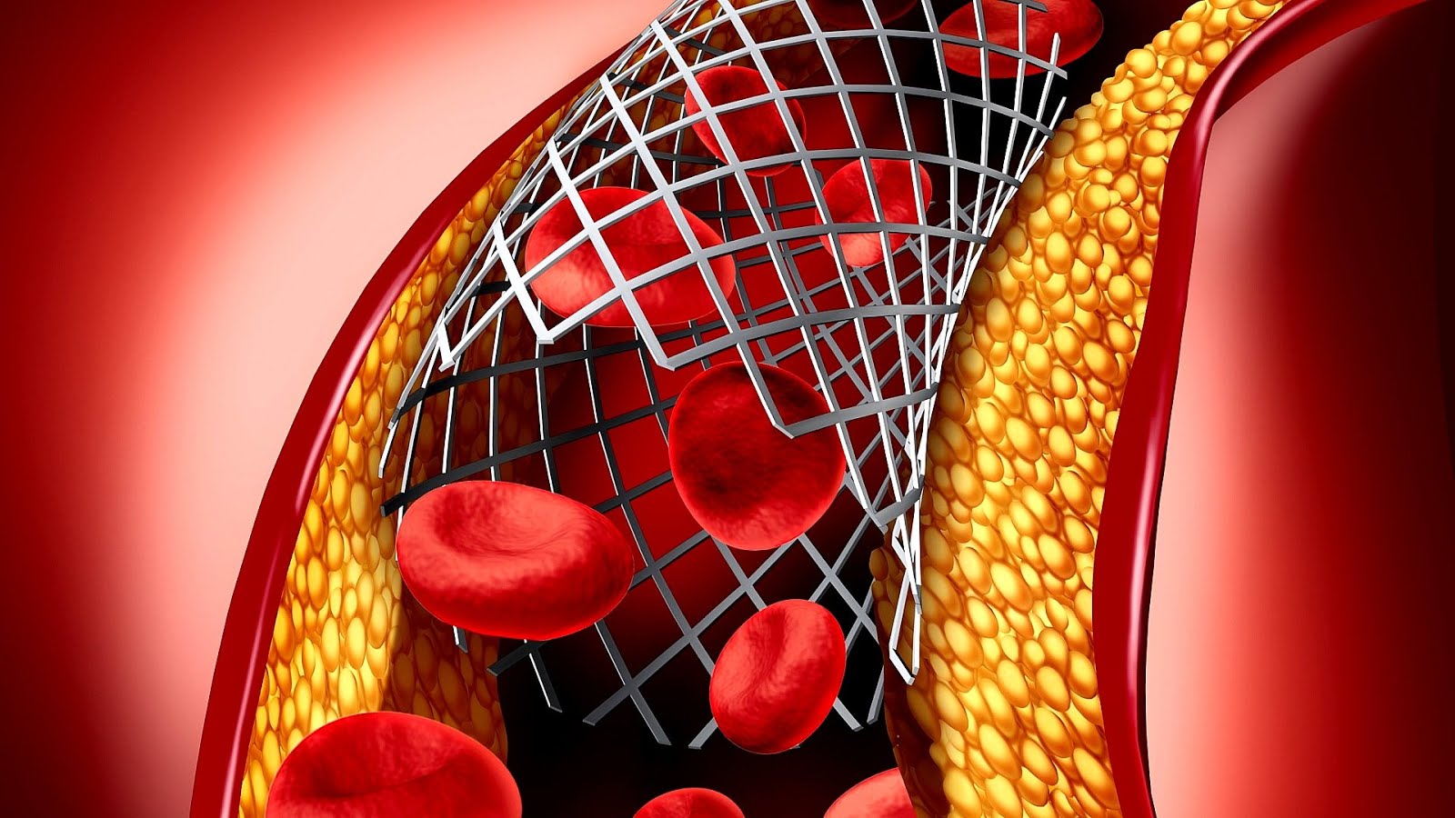 Heart Stent After Heart Attack Hear Choices