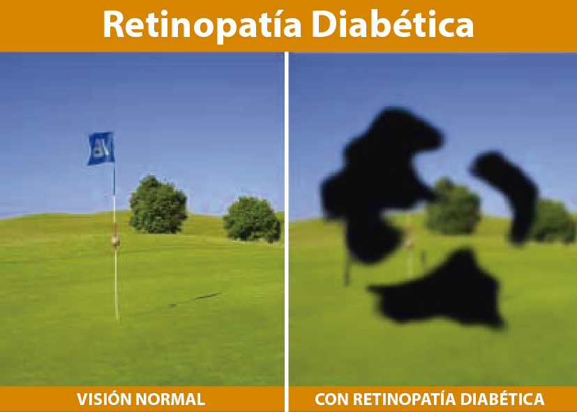 dificultades de visión y diabetes